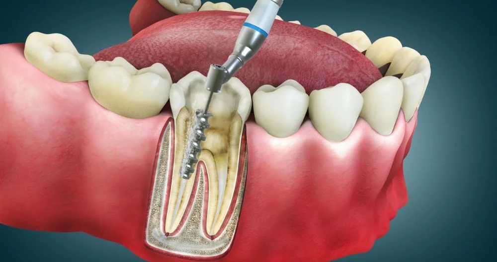 Emergency Dental Care at Dallas Dental Care